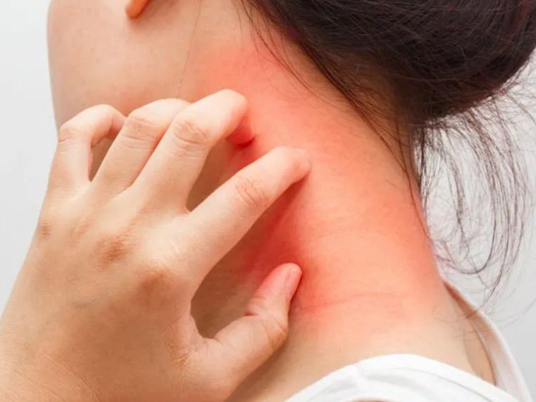 किन हुन्छ एलर्जी ? कसरी बच्ने ?